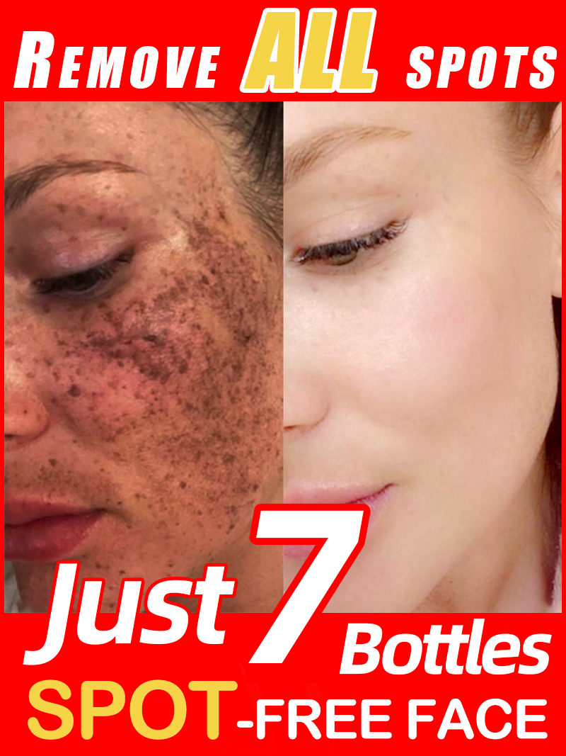 Luxury Natural Skincare - Mencerahkan Bintik-Bintik, Melasma, Flek Hitam di