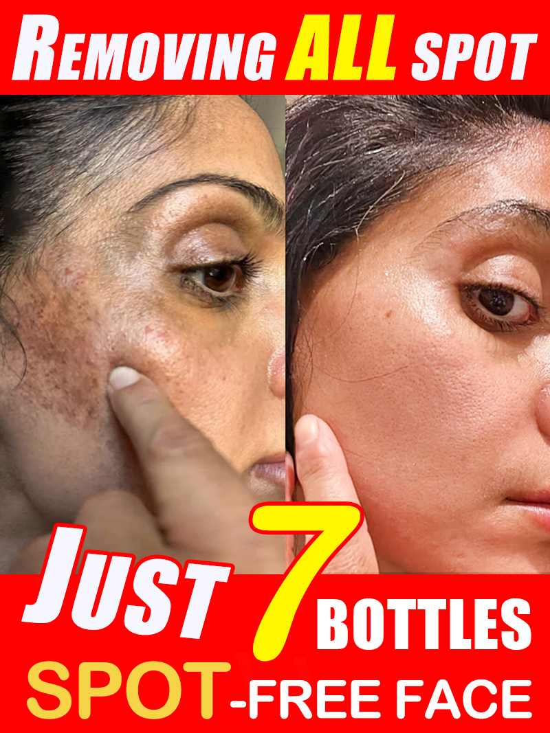 Luxury Natural Skincare - Krim untuk Menghilangkan Bintik Hitam di